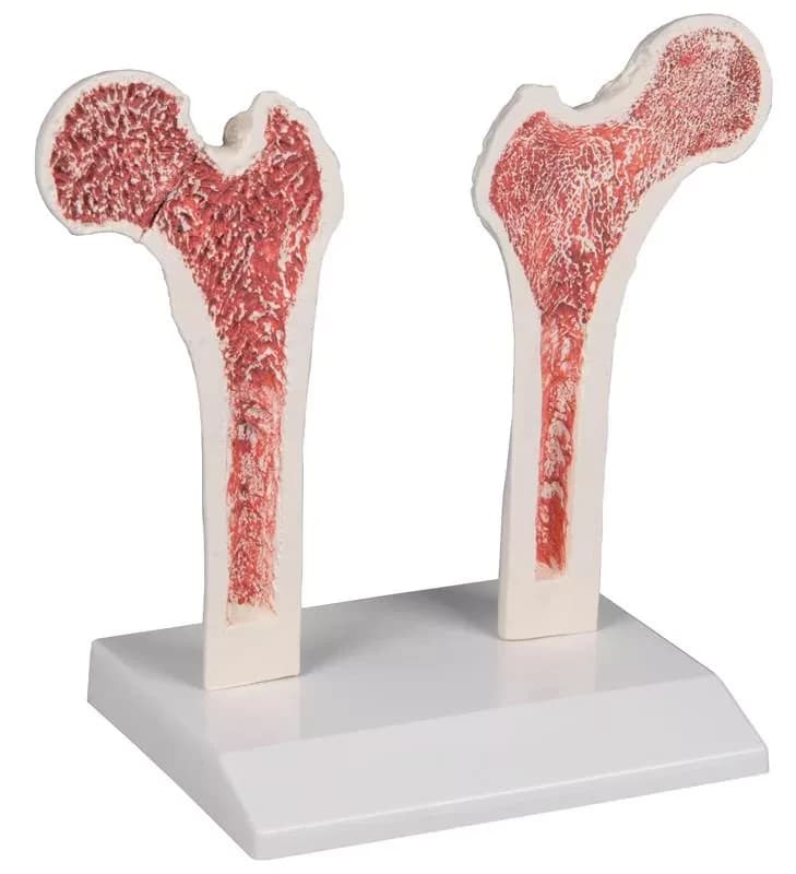 Osteoporos Lårben